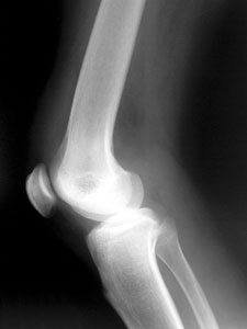 Knee X-Ray