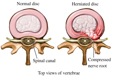 Herniated Disk