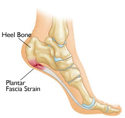 plantar fasciitis